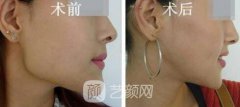 成都磨骨多少钱