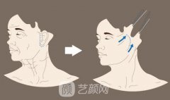 冰电波拉皮的价格多少钱？