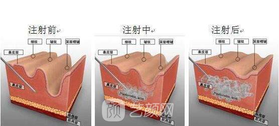 【微创除皱术有哪些？微创除皱术有什么优势？】