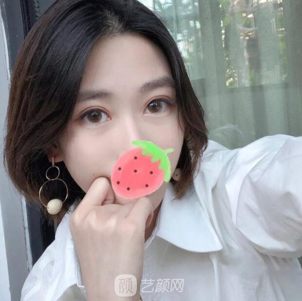 东莞美立方单眼皮割双眼皮图|内附手术全程恢复
