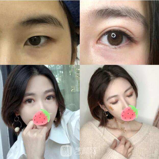 东莞美立方单眼皮割双眼皮图|内附手术全程恢复