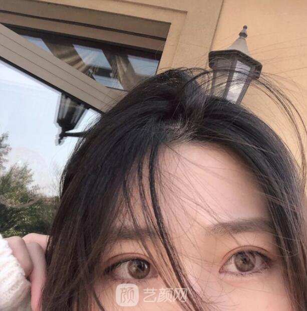东莞美立方单眼皮割双眼皮图|内附手术全程恢复