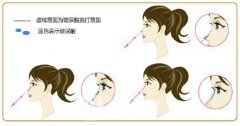胶原蛋白隆鼻价格是多少