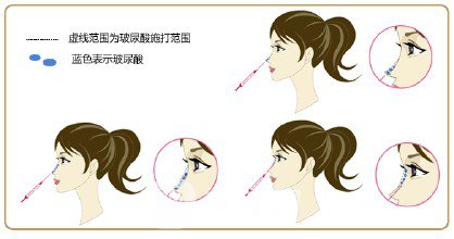 玻尿酸隆鼻的价格是多少呢