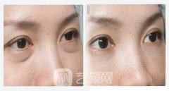 西安微创去眼袋多少钱?