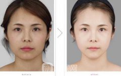北京做改脸型手术要多少钱？
