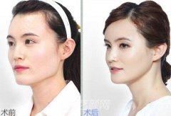 改脸型手术多少钱？手术果好不好？