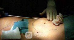 环形吸脂价格多少钱？手术果怎么样？
