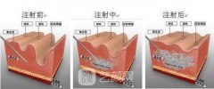 伊维兰除皱多少钱？果能维持多久？