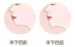 伊维兰丰下巴多少钱？需要注意什么？