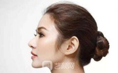 双美胶原蛋白隆鼻的价格