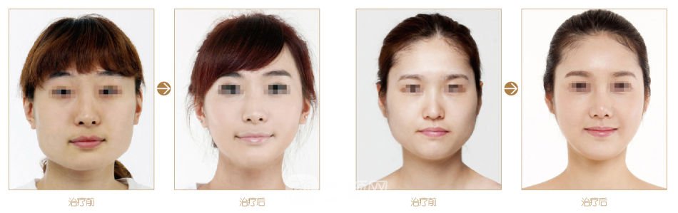 非手术面部提升是什么方法