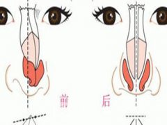 上海驼峰鼻矫正多少钱