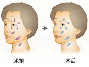 成都像素射频除皱手术之后可以保持多久