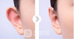 北京招风耳手术多少钱