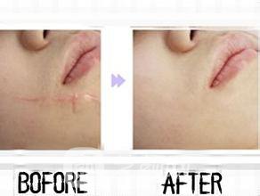 像素激光调节痘疤没问题吗