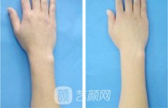 激光脱毛手术大概需要多少钱呢