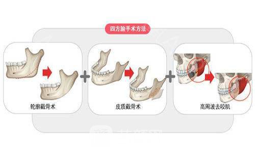 肥胖下颌角整型术前术后要注意什么