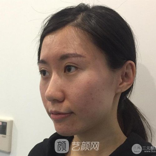 成都玉之光刘中国自体脂肪面部填充一个月案例~