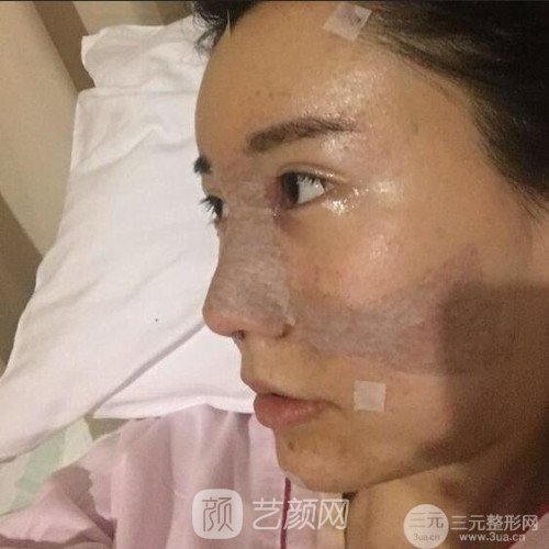 成都玉之光刘中国自体脂肪面部填充一个月案例~