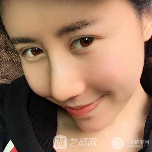 成都玉之光刘中国自体脂肪面部填充一个月案例~