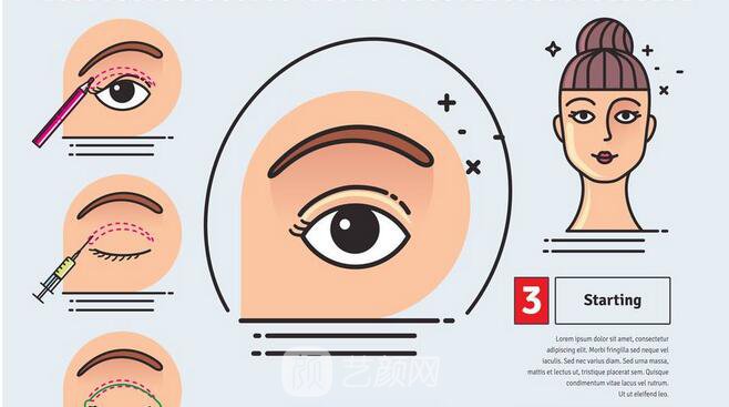 上眼睑成形术、下眼睑成形术的恢复情况是怎样的?