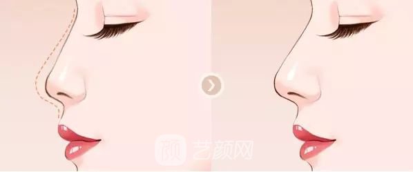隆鼻整形手术前的准备工作有哪些？
