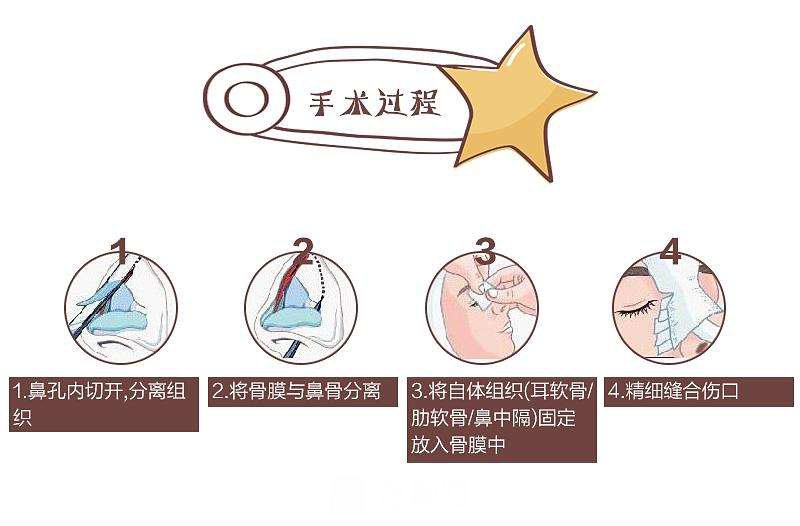 隆鼻失败修复手术是怎样的一份工作呢？