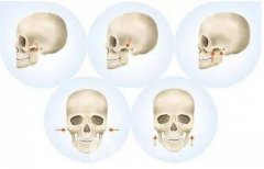 下颌3d缩小术危险吗？有哪些风险？