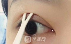 3d美雕双眼皮好不好？3d美雕双眼皮果怎么样？