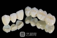 3d美牙冠如何修复？3d美牙冠果逼真吗？