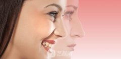 鼻整形术的5种类型分别是哪些