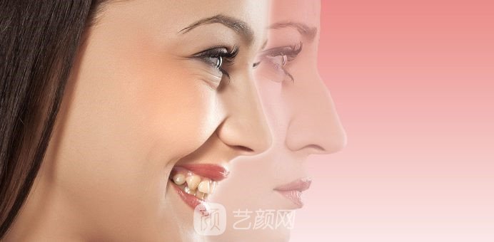 鼻整形术的5种类型分别是哪些