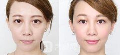 成都外切去眼袋多少钱