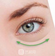 去眼袋失败修复方法有什么