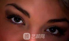 埋线双眼皮多少钱？埋线双眼皮多久恢复自然？
