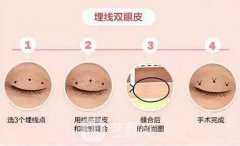 埋线双眼皮后遗症有哪些？需要注意什么？
