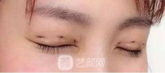 韩式定点双眼皮是什么？术后注意事项