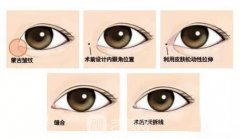 开外眼角多久恢复?术后注意事项有哪些?
