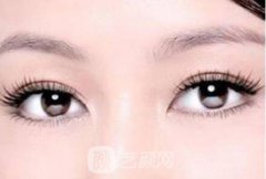 吸雕双眼皮是怎么做的？吸雕双眼皮哪里能做？