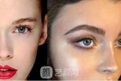 欧式双眼皮怎么做？欧式双眼皮果怎么样？