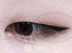 外眼角下拉术果好不好?