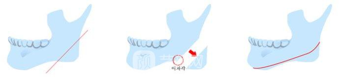 下颌角磨骨有哪些风险？