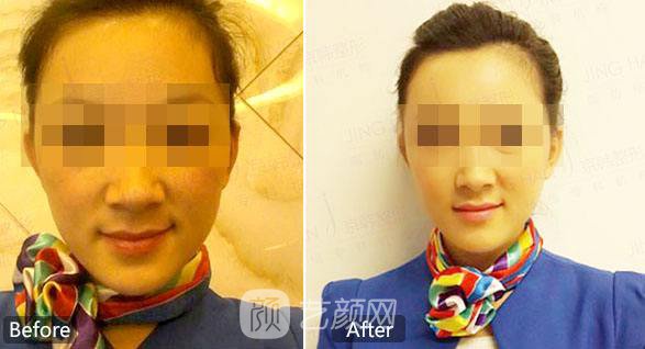 自体脂肪丰面颊有副作用吗？自体脂肪丰面颊副作用有哪些？