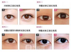 3d微创双眼皮可以维持多长时间
