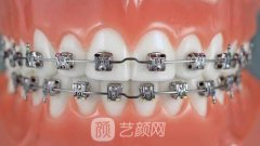 3d美牙矫正价格多少钱？3d美牙矫正要多长时间？