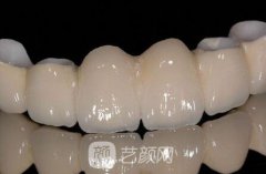3d烤瓷牙的危害大不大？有什么副作用？