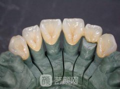 3d烤瓷牙能使用寿命果能管多久？