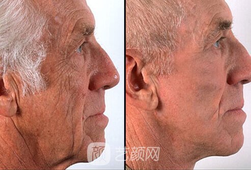 面部提升果图