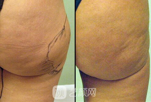 吸脂术果图